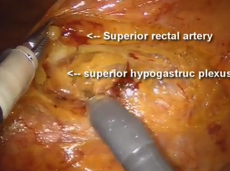 Reduced-port Total Mesorectal Resection for Rectal Cancer using the Robotic Single-Site Platform Reduced-port Total Mesorectal Resection for Rectal Cancer using the Robotic Single-Site Platform