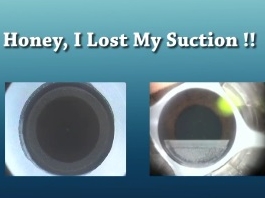 Chirurgie réfractive - Chérie, je perdu mon aspiration!