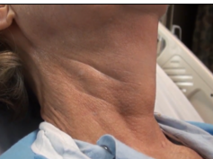 Regular Carotid Pulsation and Discernible Internal Jugular Venous Pulse