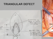 Repair of a complex vaginal J-pouch fistula utilizing a gracilis muscle interposition Repair of a complex vaginal J-pouch fistula utilizing a gracilis muscle interposition