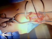 Repair of Common Femoral Vein Aneurysm Repair of Common Femoral Vein Aneurysm