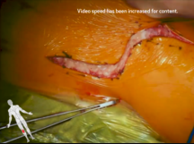 Repair of Popliteal Vein Aneurysm Repair of Popliteal Vein Aneurysm
