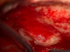 Repair of Superior Semicircular Canal Dehiscence via MCF approach