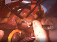 Repair of tricuspid papillary muscle rupture
