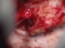 Resection of tympanic paraganglioma (glomus tympanicum)