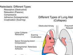 Respiratory System - Chest Conditions- Atelectasis - Part 1 Respiratory System - Chest Conditions- Atelectasis - Part 1