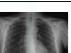Respiratory system, X ray Chest, Pneumonia Respiratory system, X ray Chest, Pneumonia