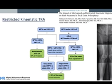 Restricted Kinematic Alignment TKA Using Computer Assisted Surgery