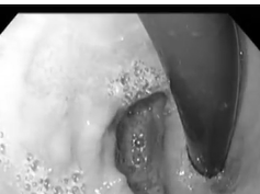 Retained Fundus after Sleeve Gastrectomy