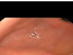 Retained Fundus In A Paraesophageal Hernia after Sleeve Gastrectomy