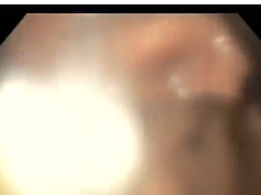 Retained Pill In Stomach