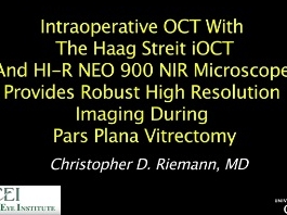 Rétine, Corps Vitreux - La tomographie peropératoire par cohérence optique avec les microscopes Haag-Streit IOCT et HI-R NEO 900 NIR fournit une imagerie robuste à haute résolution durant une virectomie de la pars plana