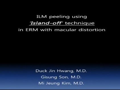 Retina, Vitreous - Island-Off Technique for Internal Limiting Membrane Peeling in Epiretinal Membrane With Macular Distortion