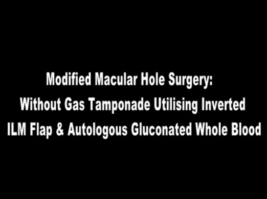 Retina, Vitreous - Modified Macular Hole Surgery Without Gas Tamponade: Utilizing Inverted ILM Flap and Autologous Gluconated Whole Blood