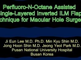 Rétine, Corps Vitreux - Le Perfluoro-N-Octane en monocouche interne inversée limite la technique du lambeau de membrane pour la chirurgie du trou maculaire