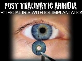 Rétine, Corps Vitreux - Aniridie post-traumatique: iris artificiels combinés avec implantation d'une lentille intraoculaire Rétine, Corps Vitreux - Aniridie post-traumatique: iris artificiels combinés avec implantation d'une lentille intraoculaire