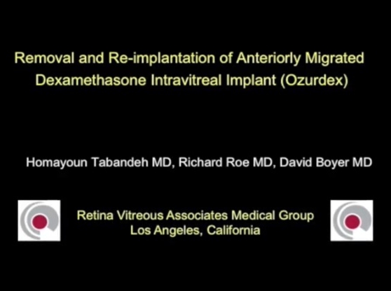 Retina, Vitreous - Removal and Reimplantation of Anteriorly Migrated Dexamethasone Intravitreal Implant (Ozurdex)