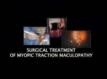 Retina, Vitreous - Surgical Treatment of Myopic Traction Maculopathy