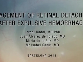 Rétine, Corps Vitreux - Le traitement chirurgical du décollement post-traumatique de la rétine après une hémorragie expulsive suprachoroïdienne Rétine, Corps Vitreux - Le traitement chirurgical du décollement post-traumatique de la rétine après une hémorragie expulsive suprachoroïdienne