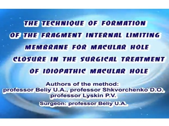 Retina, Vitreous - The Technique of Formation of the ILM Fragment for Macular Hole Closure in the Surgical Treatment of Large Macular Hole