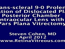 Rétine, Corps Vitreux -  Fixation transsclérale au prolène 9-0 d'une plaque de silicone disloquée dans la chambre postérieure - Lentille intra-oculaire Rétine, Corps Vitreux -  Fixation transsclérale au prolène 9-0 d'une plaque de silicone disloquée dans la chambre postérieure - Lentille intra-oculaire