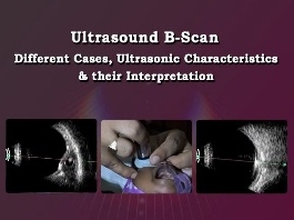 Rétine, Corps Vitreux - Ultrasound à balayage B : Différents cas, caractéristiques des ultrasons, et leur interprétation Rétine, Corps Vitreux - Ultrasound à balayage B : Différents cas, caractéristiques des ultrasons, et leur interprétation
