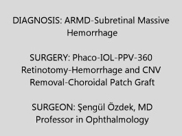 Rétine, Corps Vitreux - Vitrectomie avec un patch choroïde-RPE  contre l'hémorragie massive associée à la DMLA néovasculaire Rétine, Corps Vitreux - Vitrectomie avec un patch choroïde-RPE  contre l'hémorragie massive associée à la DMLA néovasculaire