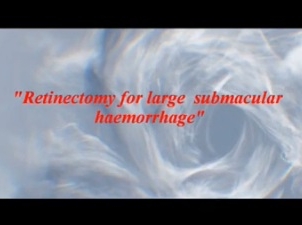 Retina, Vitreous - What Lies Beneath! Retinectomy for Large Submacular Hemorrhage Retina, Vitreous - What Lies Beneath! Retinectomy for Large Submacular Hemorrhage