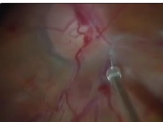 Retinal Endovascular Surgery Retinal Endovascular Surgery