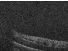 Retinoschisis Detected With Handheld Spectral-Domain Optical Coherence Tomography in Neonates With A Retinoschisis Detected With Handheld Spectral-Domain Optical Coherence Tomography in Neonates With A