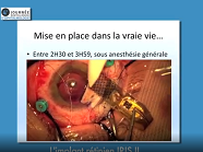 Retour dexpérience 1 an après implantations pré-rétiniennes au CHU de Nîmes