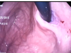 Retroflex Hiatal Hernia Hill III