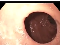 Retroflexed View of Gastric Pouch and GJ Anastomosis after Gastric Bypass