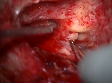 Retrolabyrinthine Approach for Endolymphatic Sac Associated Meningioma