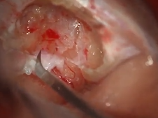 Retrosigmoid Approach for Resection of Vestibular Schwannoma with Hearing Preservation Retrosigmoid Approach for Resection of Vestibular Schwannoma with Hearing Preservation