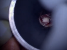 Revision Middle Ear Exploration, Ossicular Chain Reconstruction (OCR) with Clip Prosthesis