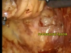 Revisiting Rectosacral and Waldeyers Fascia by Laparoscopic or Robotic Approach Revisiting Rectosacral and Waldeyers Fascia by Laparoscopic or Robotic Approach