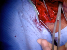 Right Claviculectomy Right Claviculectomy