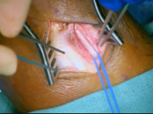 Right Superficial Femoral Artery to Dorsalis Pedis Bypass Right Superficial Femoral Artery to Dorsalis Pedis Bypass