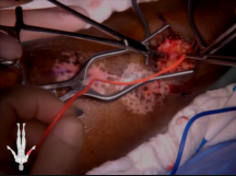 Right Upper Extremity Arteriovenous Fistula Revision Right Upper Extremity Arteriovenous Fistula Revision