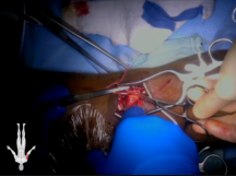 Right Upper Extremity Infected Arteriovenous Fistula Excision Right Upper Extremity Infected Arteriovenous Fistula Excision