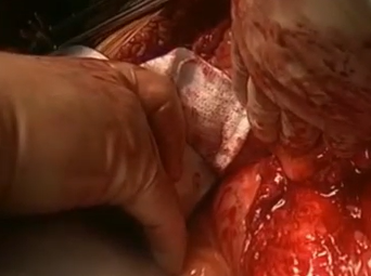 Right Visceral Rotation (Alan B. Lumsden, MD) Right Visceral Rotation (Alan B. Lumsden, MD)