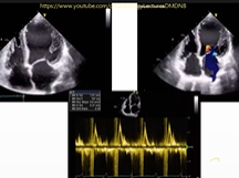 RJM Cardiology Academy Case Discussion AORTIC ROOT DILATATION Management Part 3 RJM Cardiology Academy Case Discussion AORTIC ROOT DILATATION Management Part 3