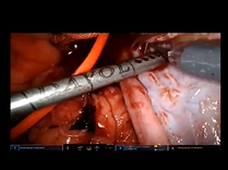 Robot Assisted Inferior Vena Cavoscopy