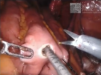 Robot Assisted Intracorporeal Approach to W Configuration Ileal Neobladder