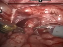 Robot assisted laparoscopic extravesical cross-trigonal ureteral re-implantation Robot assisted laparoscopic extravesical cross-trigonal ureteral re-implantation