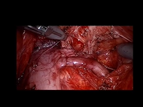 Robot Assisted Left Renal Vein Transposition