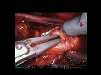 Robot Assisted Partial Nephrectomy in Crossed-Fused Ectopia