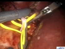 Robot-assisted partial nephrectomy (TRONES) study group