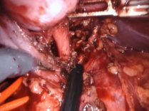 Robot-assisted renovascular reconstruction for renal artery aneurysm